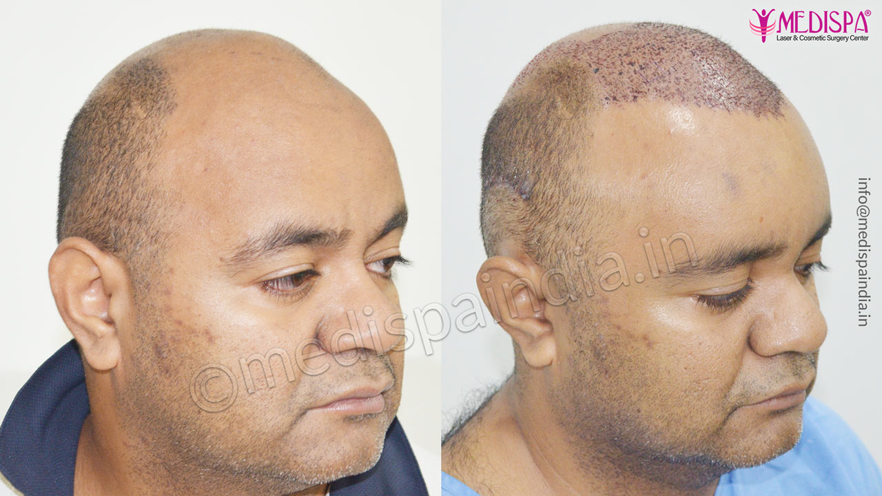 hair restoration australia before and after
