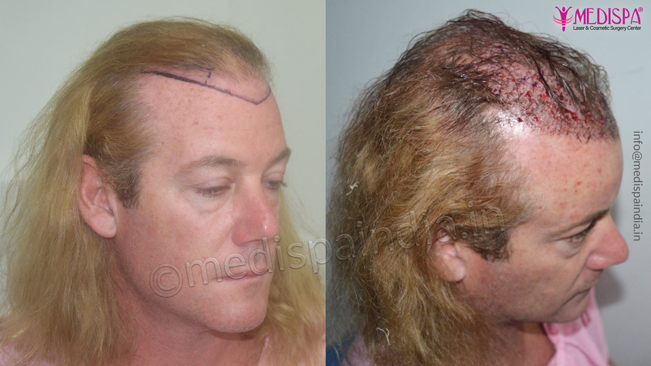 hair restoration australian results