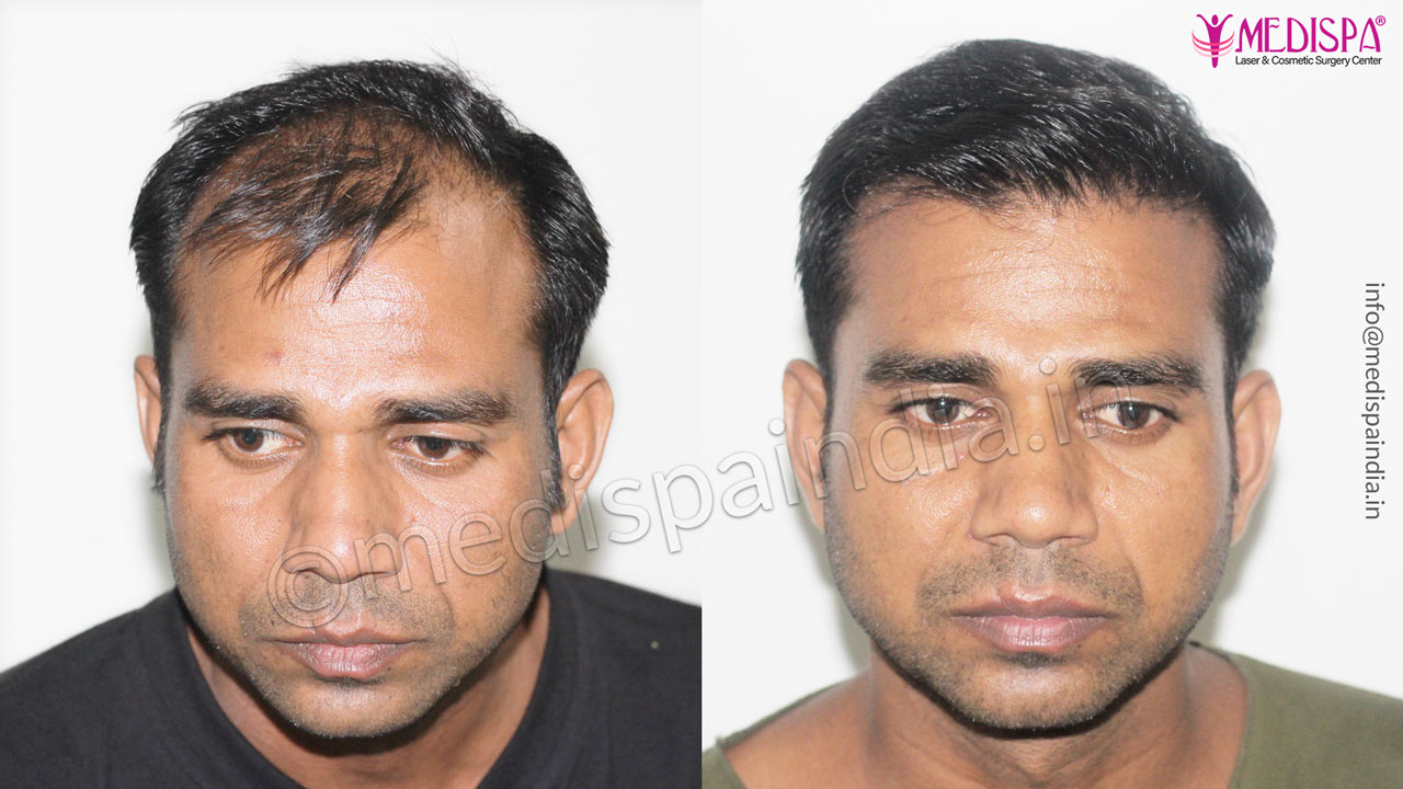 hair restoration before after india