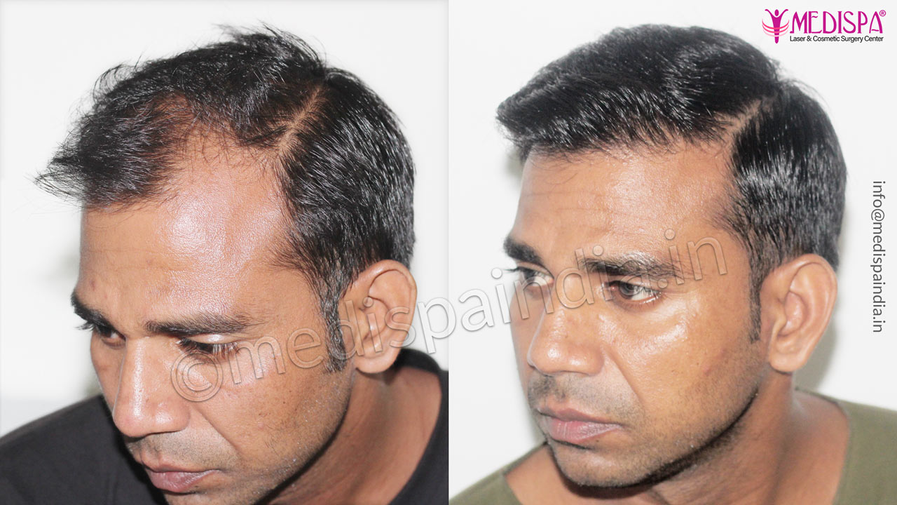hair restoration before after results
