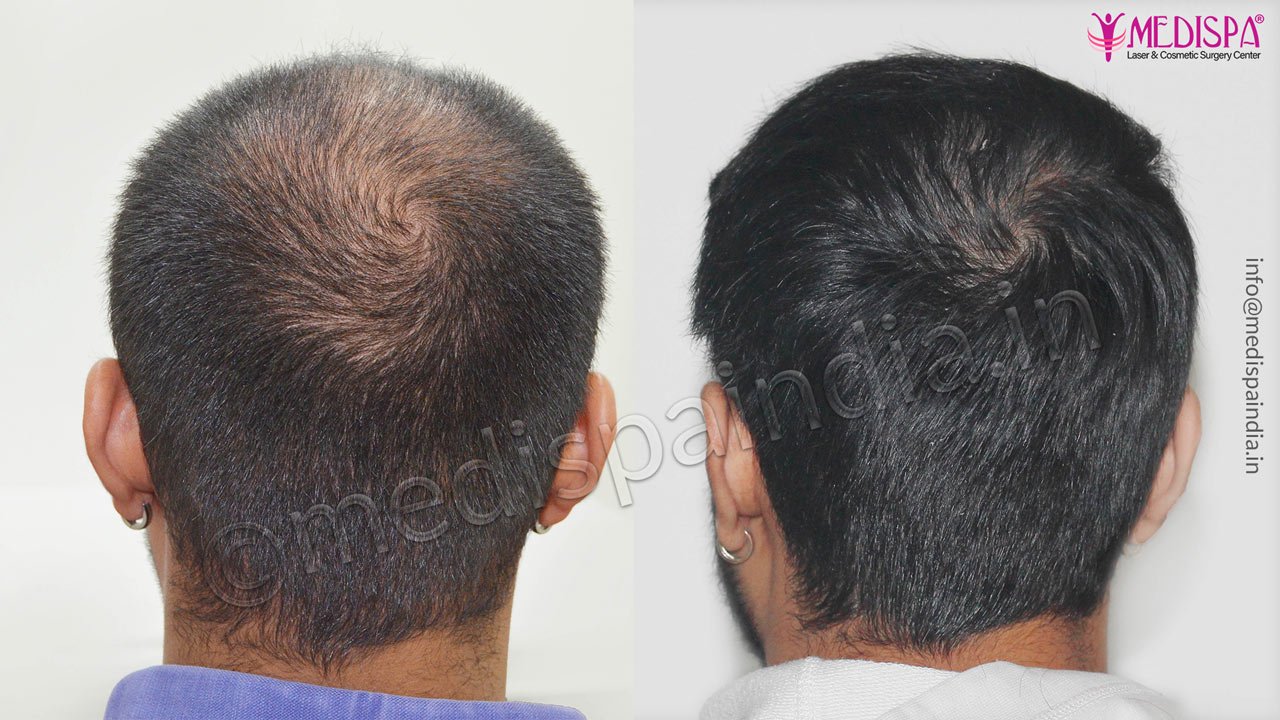 hair restoration canada