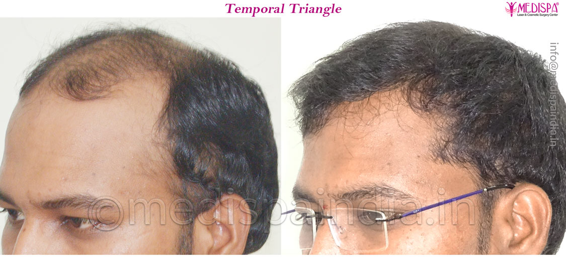 Before and After Hair Transplant Results in Bangalore, India Before and After Hair Transplant Results in Bangalore, India