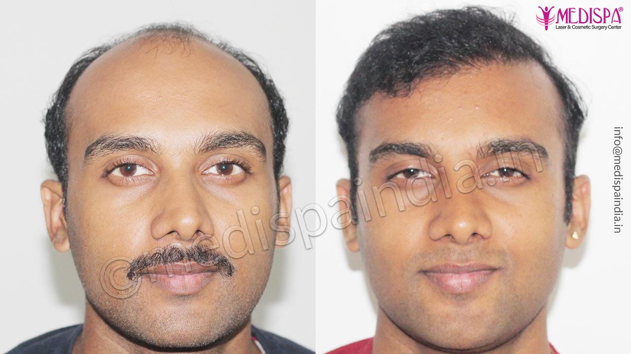 hair restoration cost india