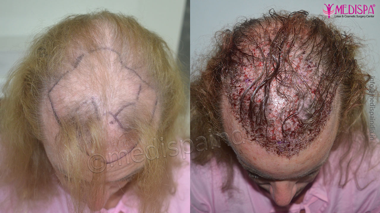 hair restoration in australia