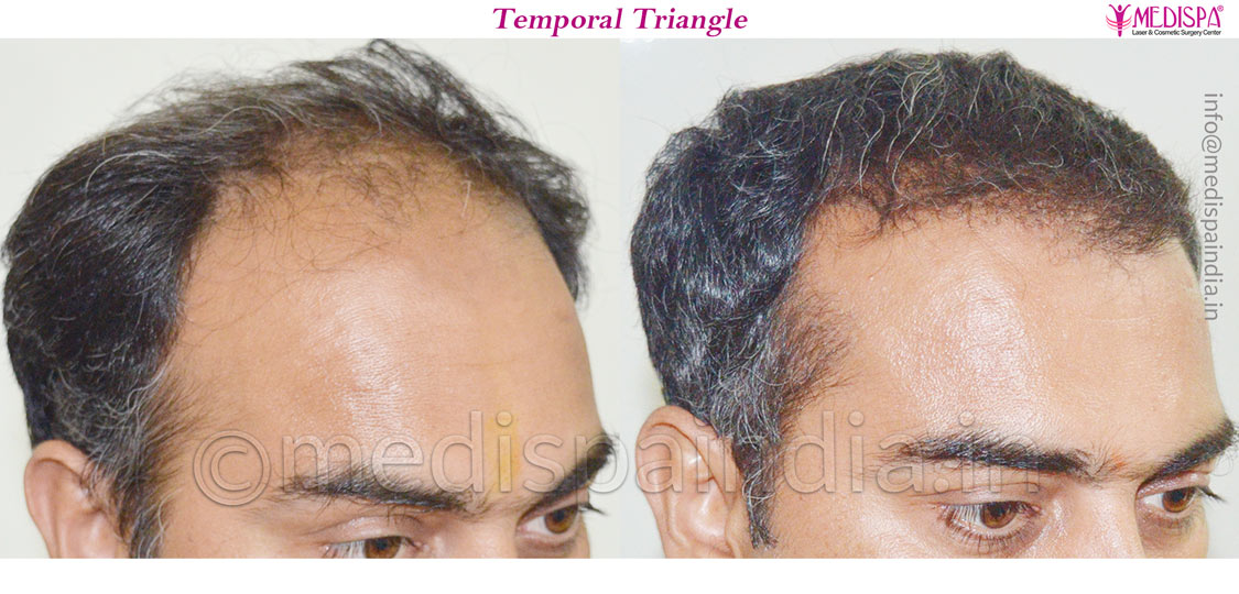 hair restoration in surat