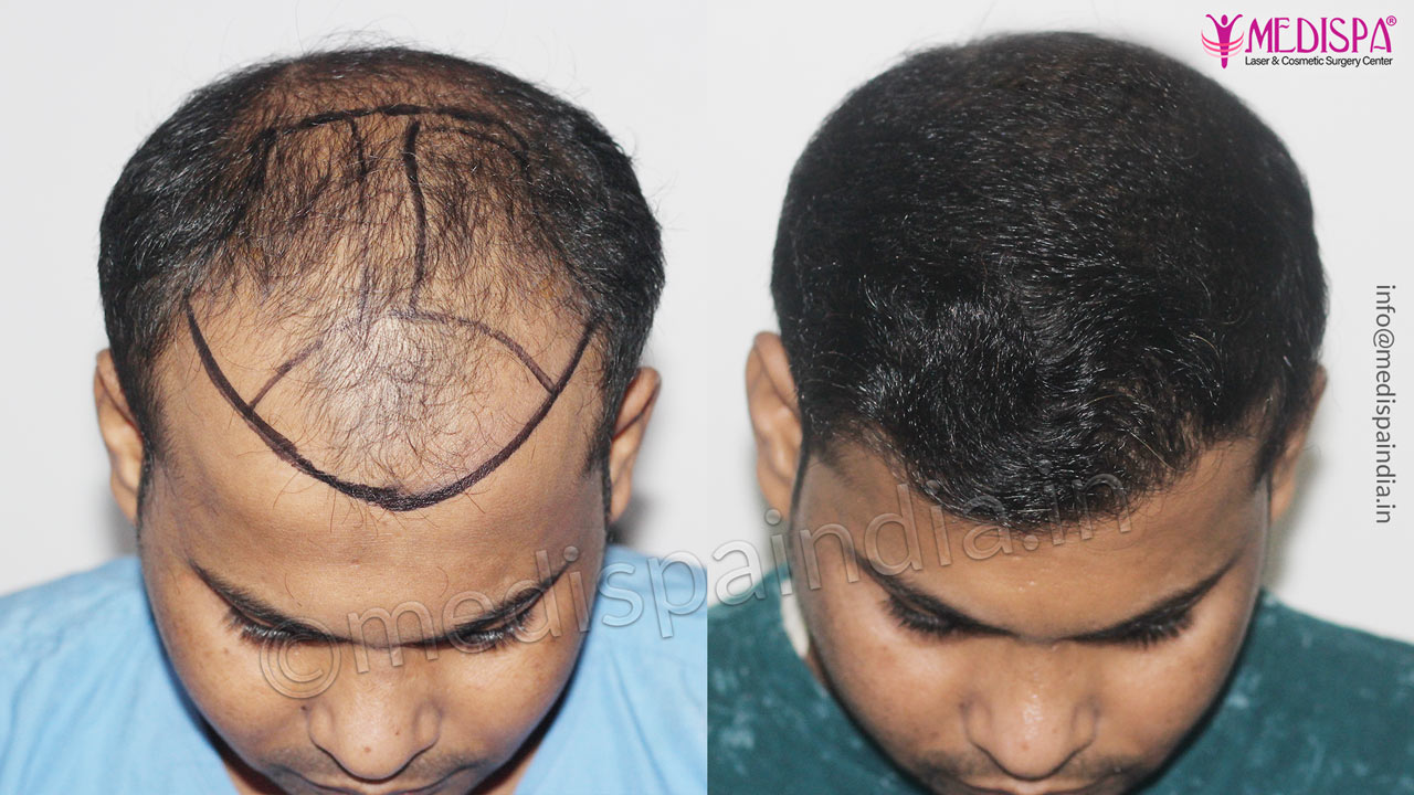 hair restoration jaipur rajasthan india