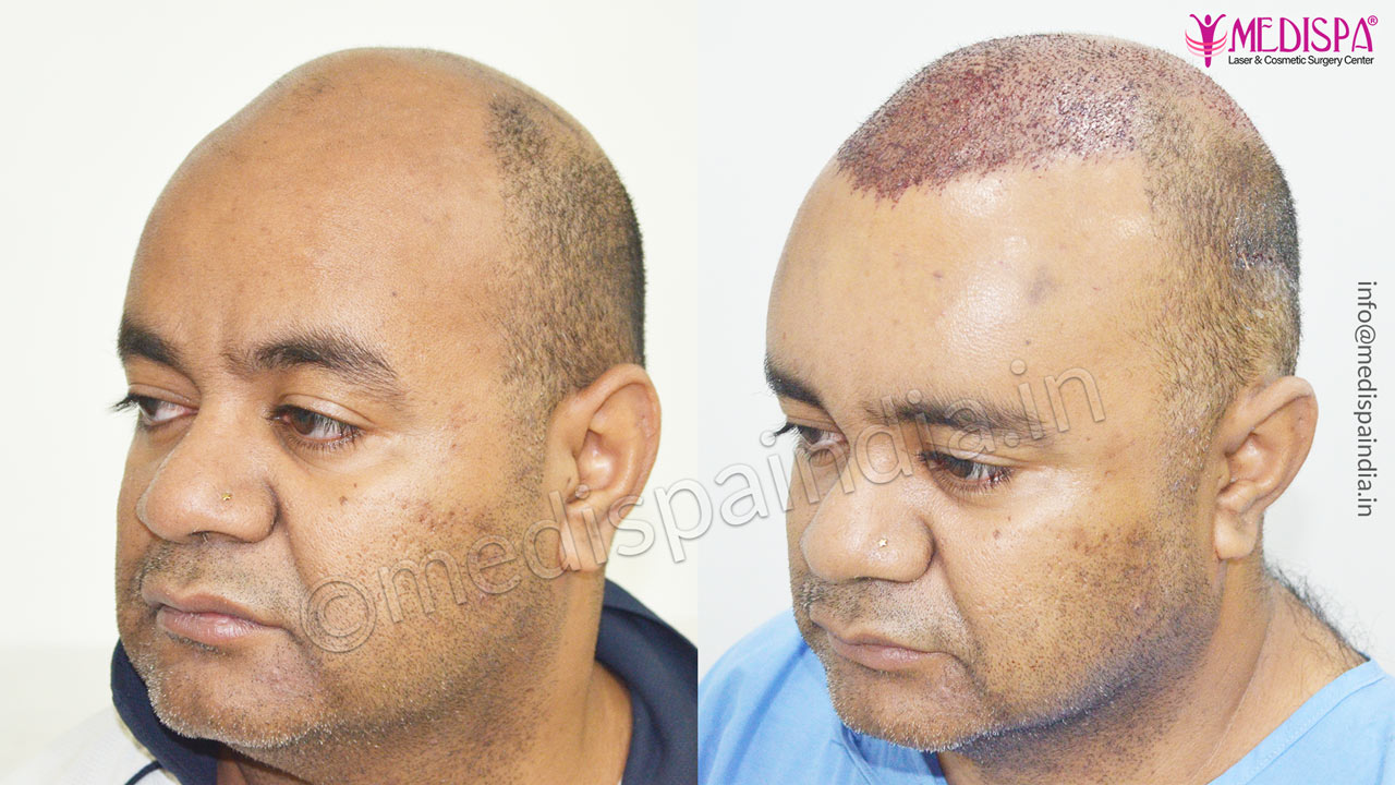 hair restoration results australia