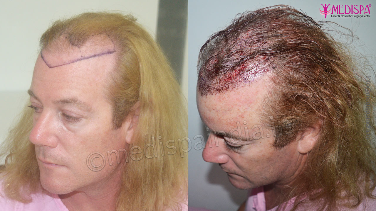 hair restoration results australia