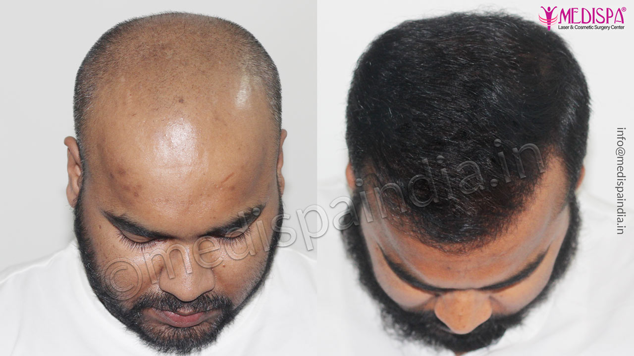 hair restoration results delhi