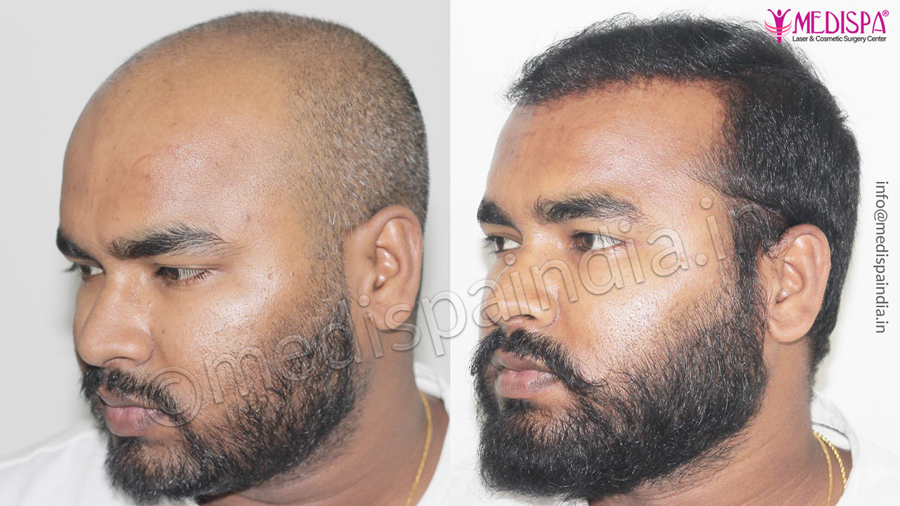 hair restoration results dubai