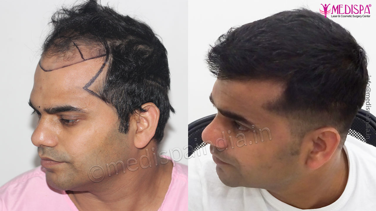 hair restoration results india