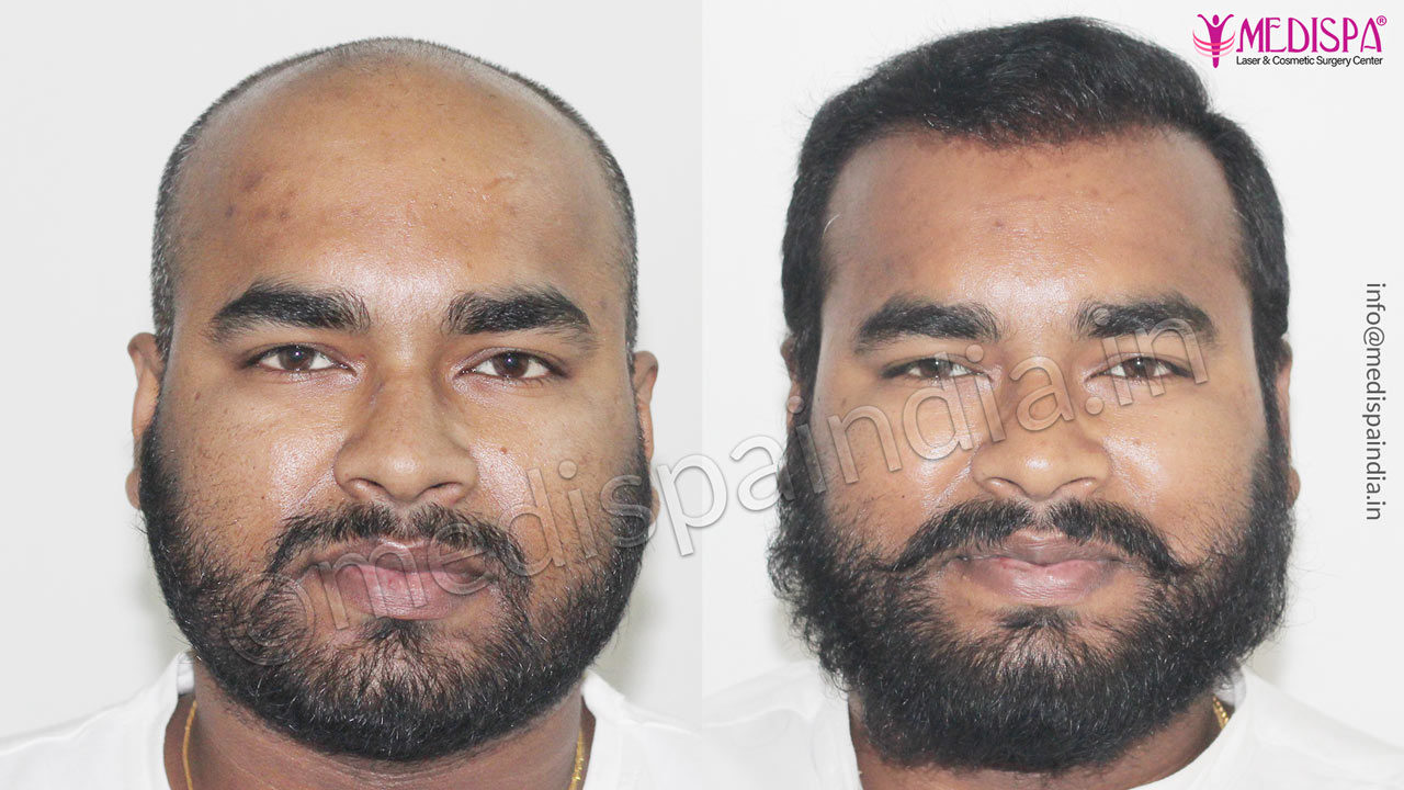 hair restoration results india