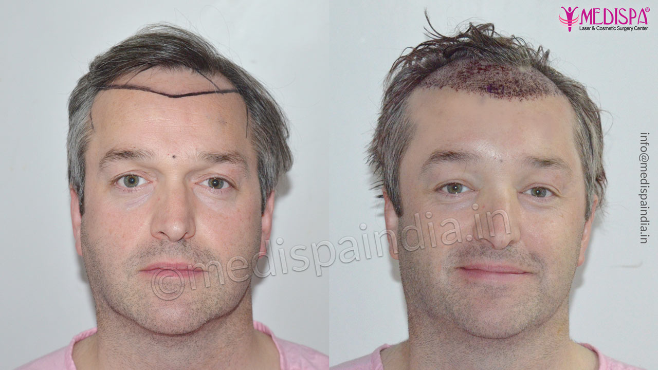 hair restoration uk results