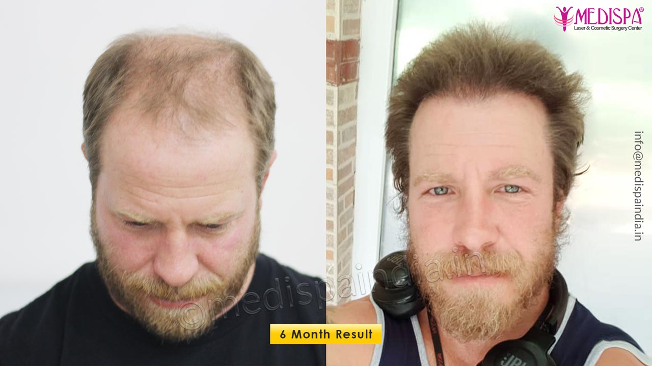 hair restoration usa patient