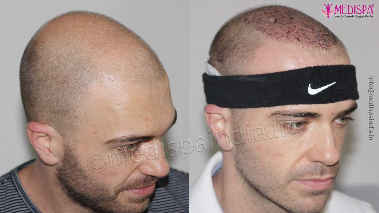 hair transplant abroad results