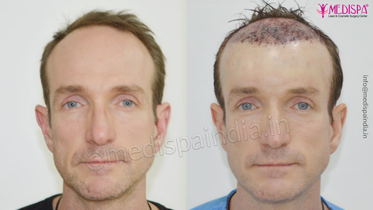 cost of hair transplant india