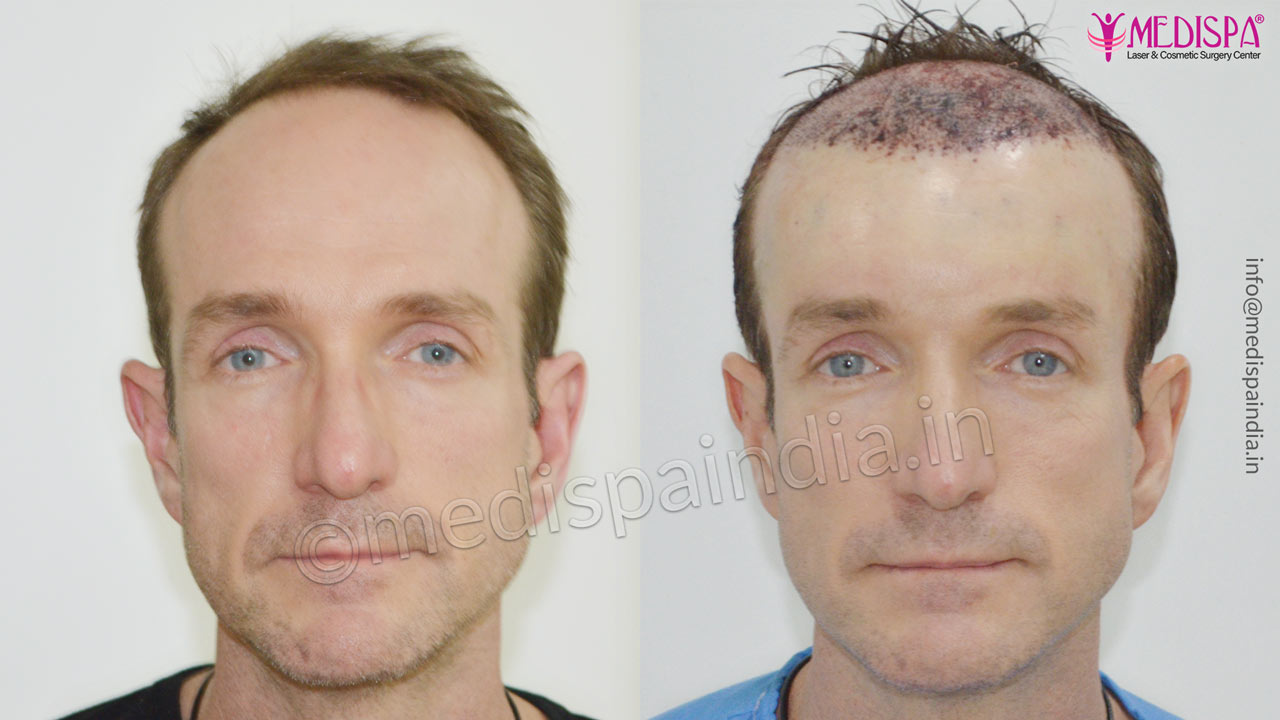 hair transplant australia