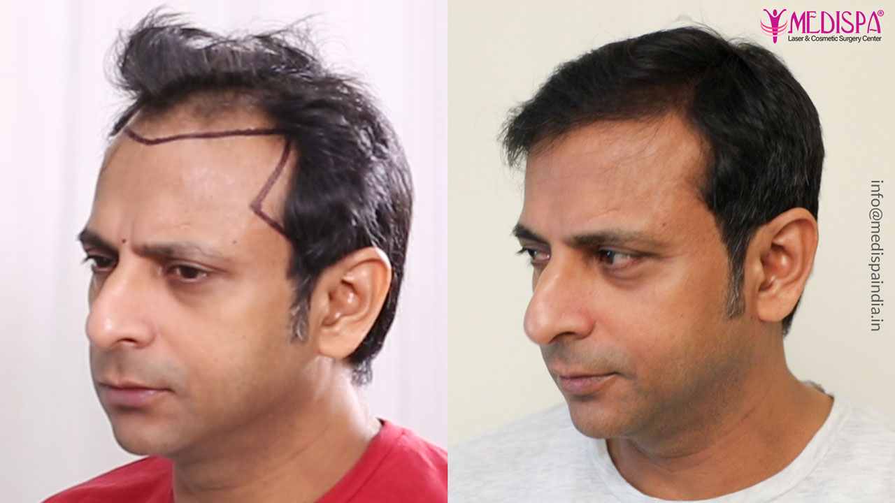 hair transplant before after celebrity