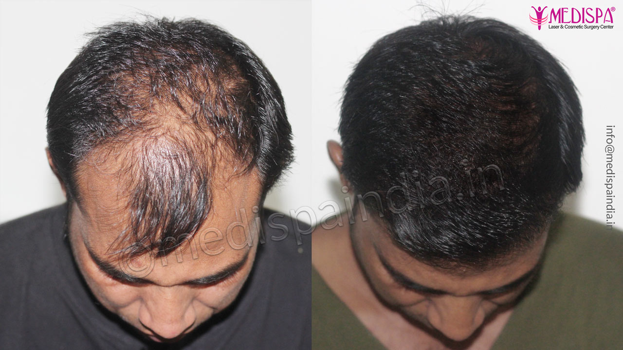 hair transplant before after delhi india