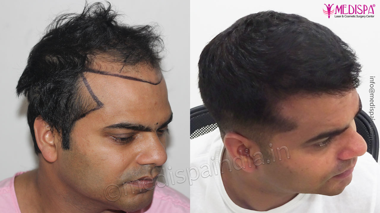 hair transplant before after jaipur india