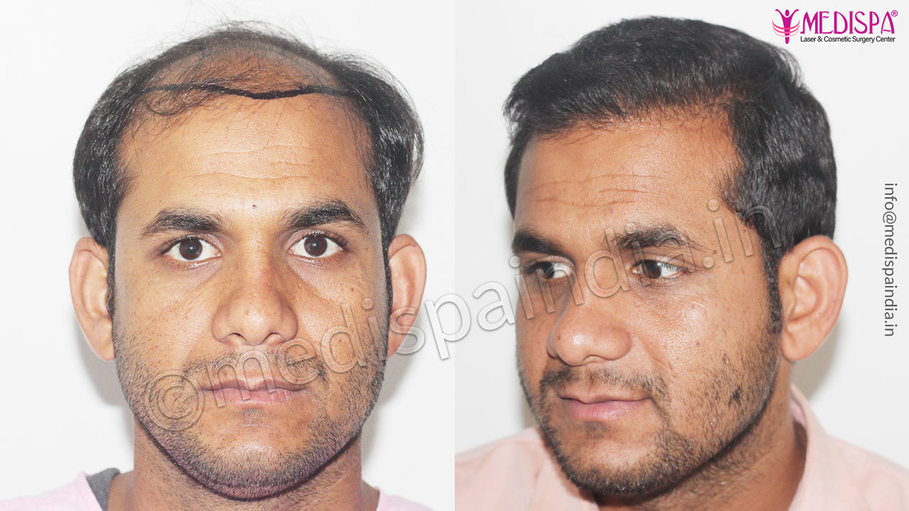 hair transplant before after results