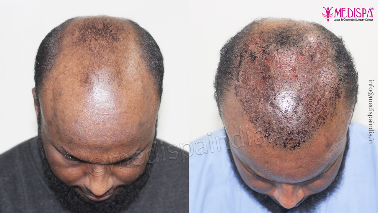 hair transplant before after sweden