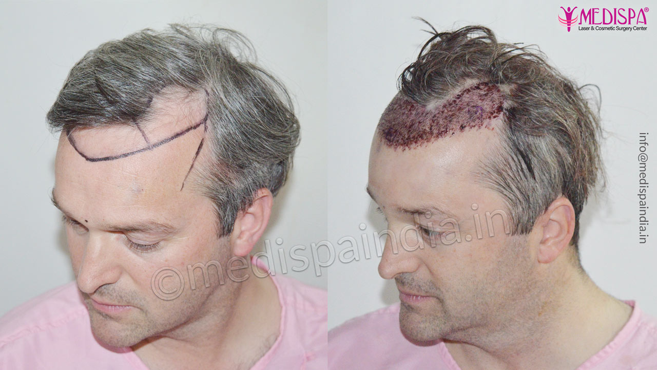 hair transplant before after uk