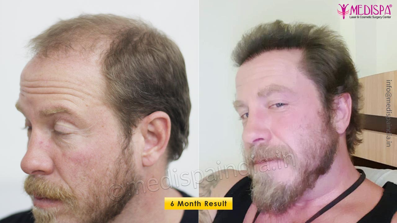 hair transplant before after usa patient