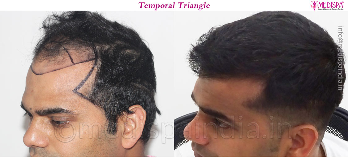 hair transplant before and after results