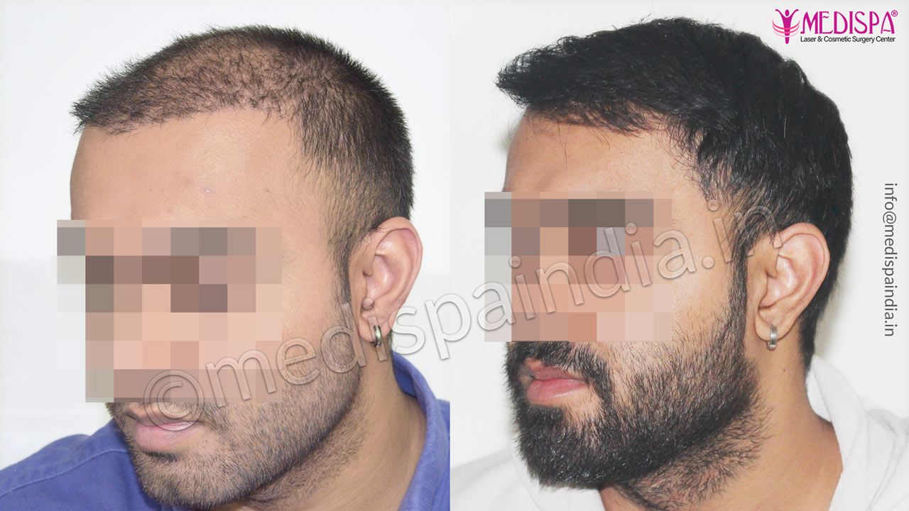 hair transplant chandigarh