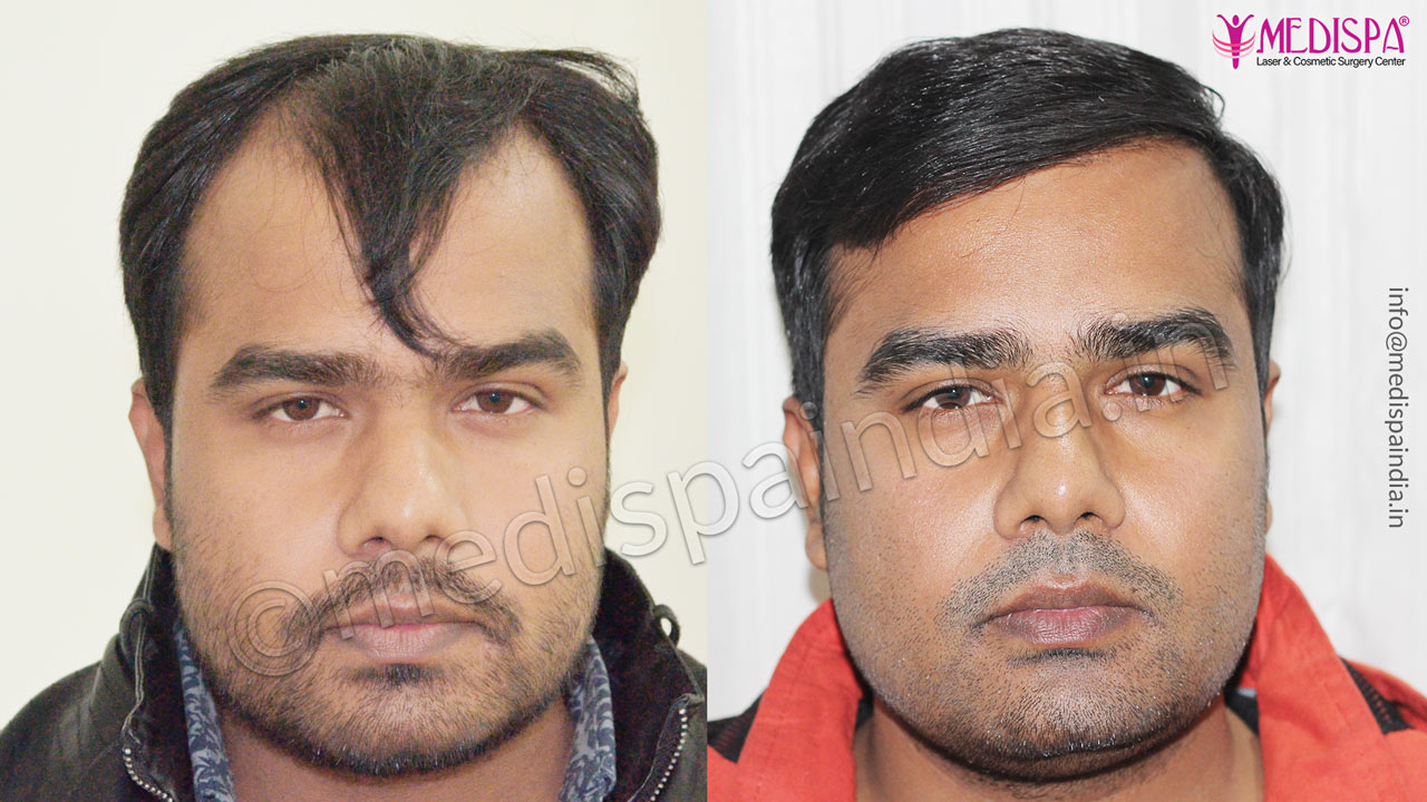 hair transplant chennai