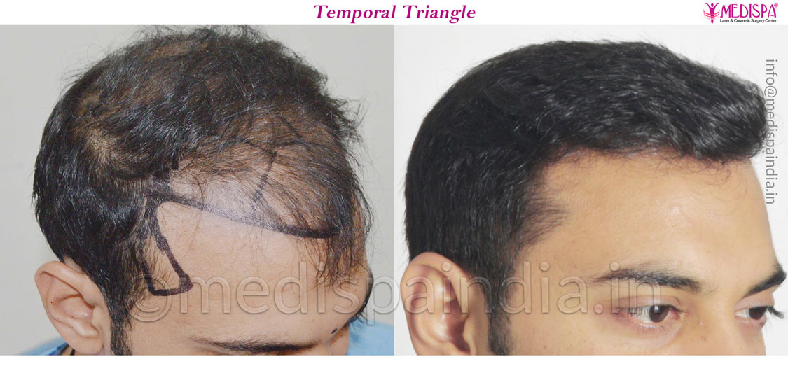 hair transplant clinic near me