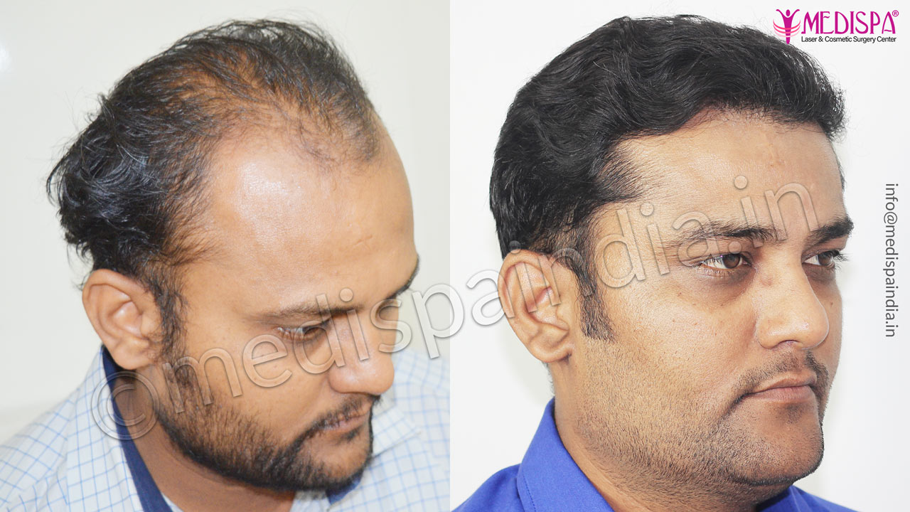 hair transplant clinics in bangladesh