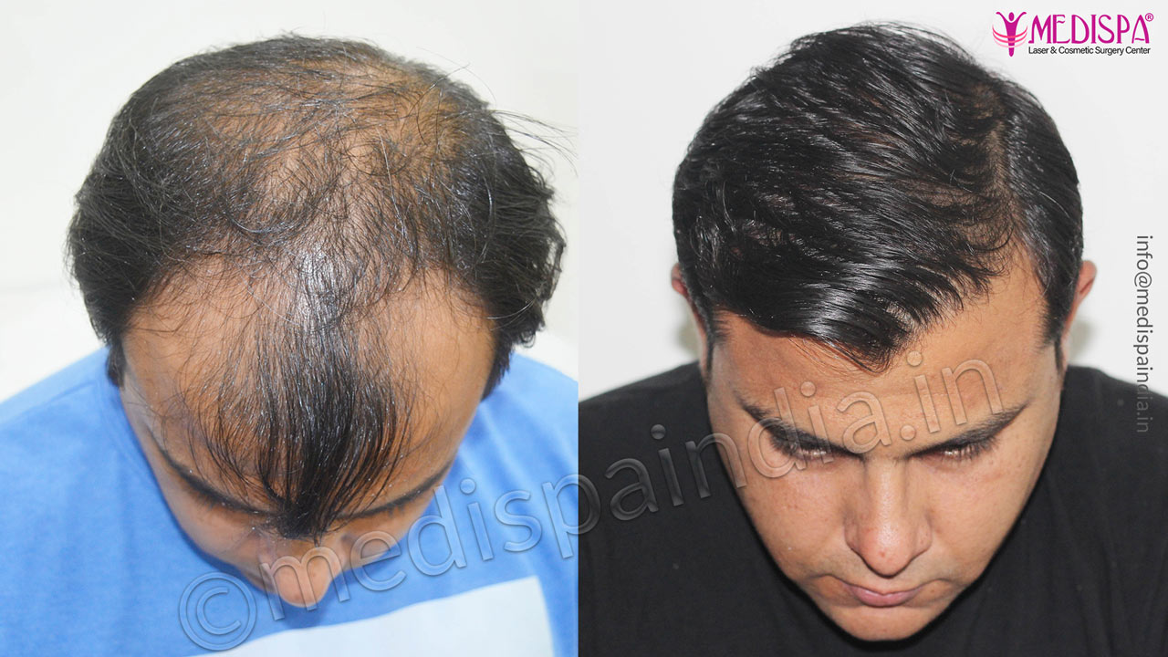 hair transplant clinics in bhubhneshwar