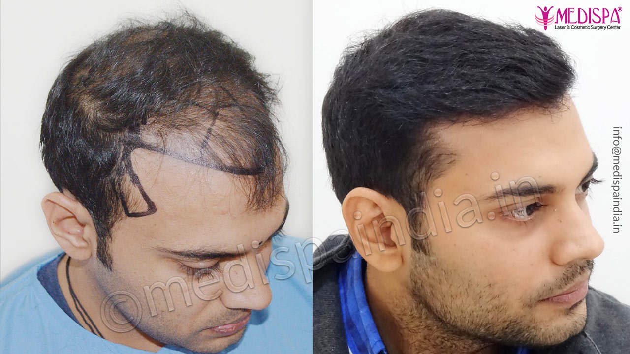 hair transplant clinics in chandigarh