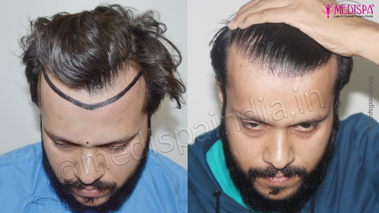 hair transplant clinics in chandigarh