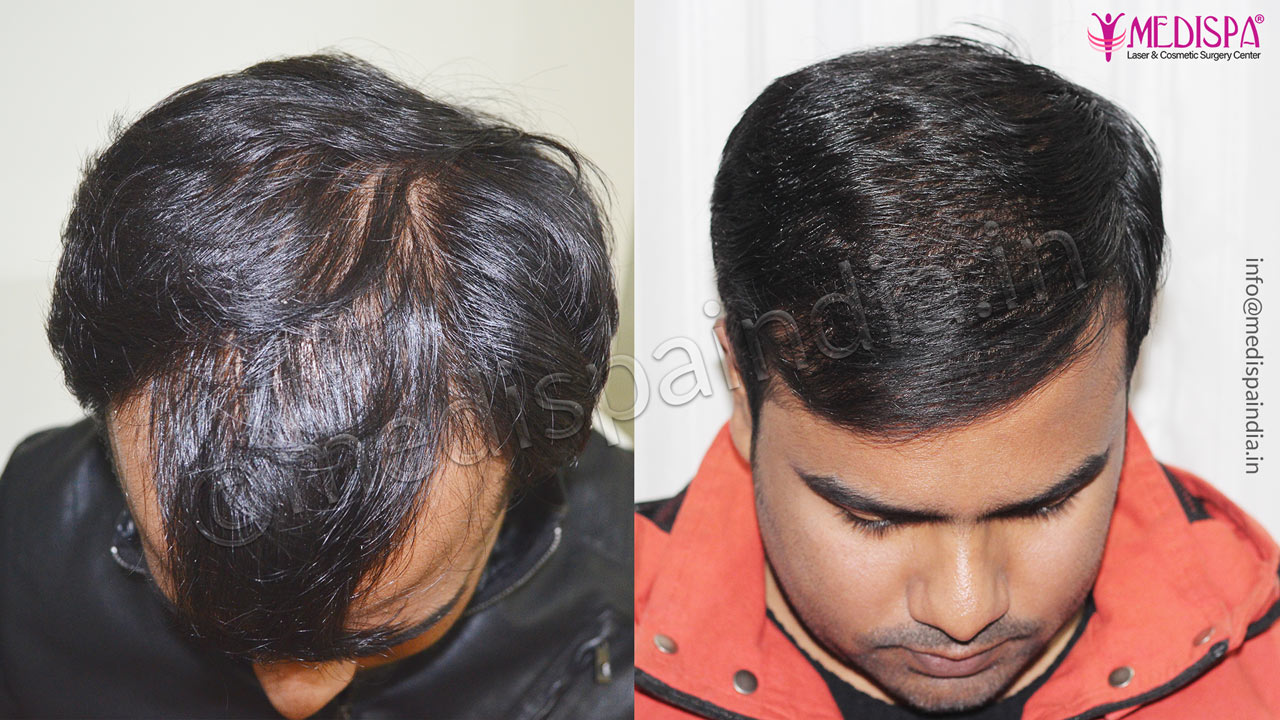 hair transplant clinics in chennai