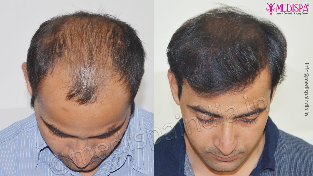 hair transplant clinics in delhi