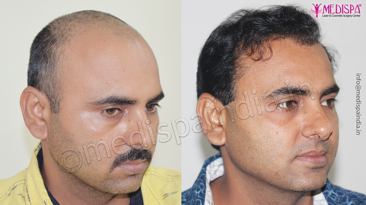 hair transplant clinics in faridabad