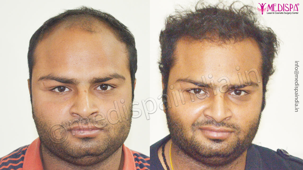 hair transplant clinics in greater kailash