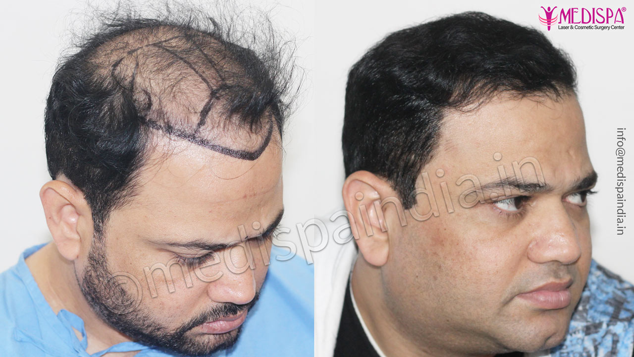 hair transplant clinics in hyderabad