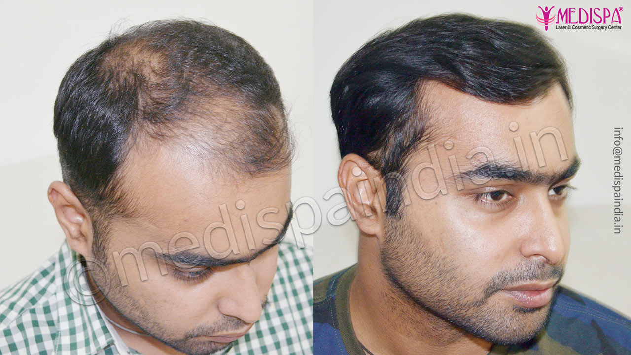 hair transplant clinics in indore
