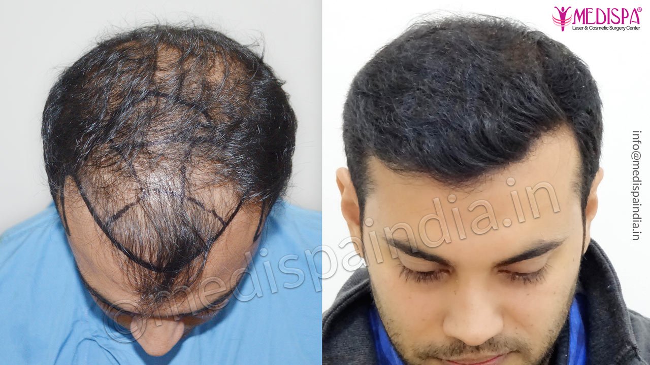 hair transplant clinics in jaipur rajasthan