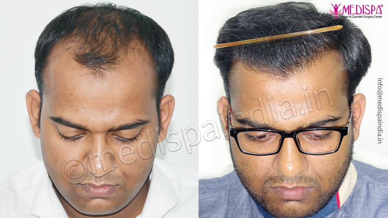 hair transplant clinics in jaipur rajasthan