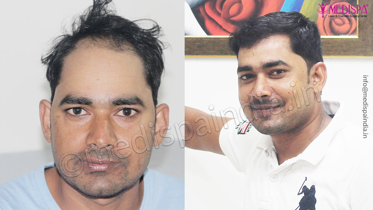 hair transplant clinics results mumbai