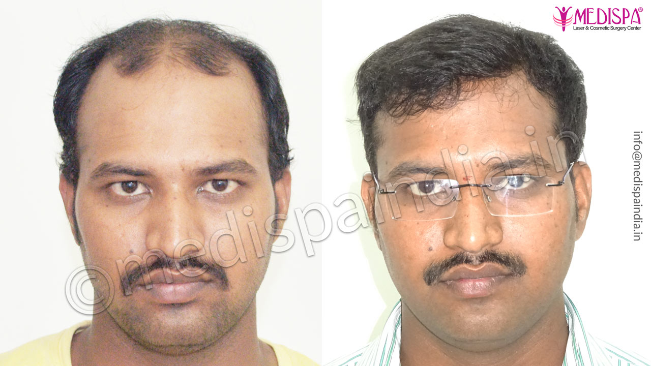 hair transplant cost bangalore india