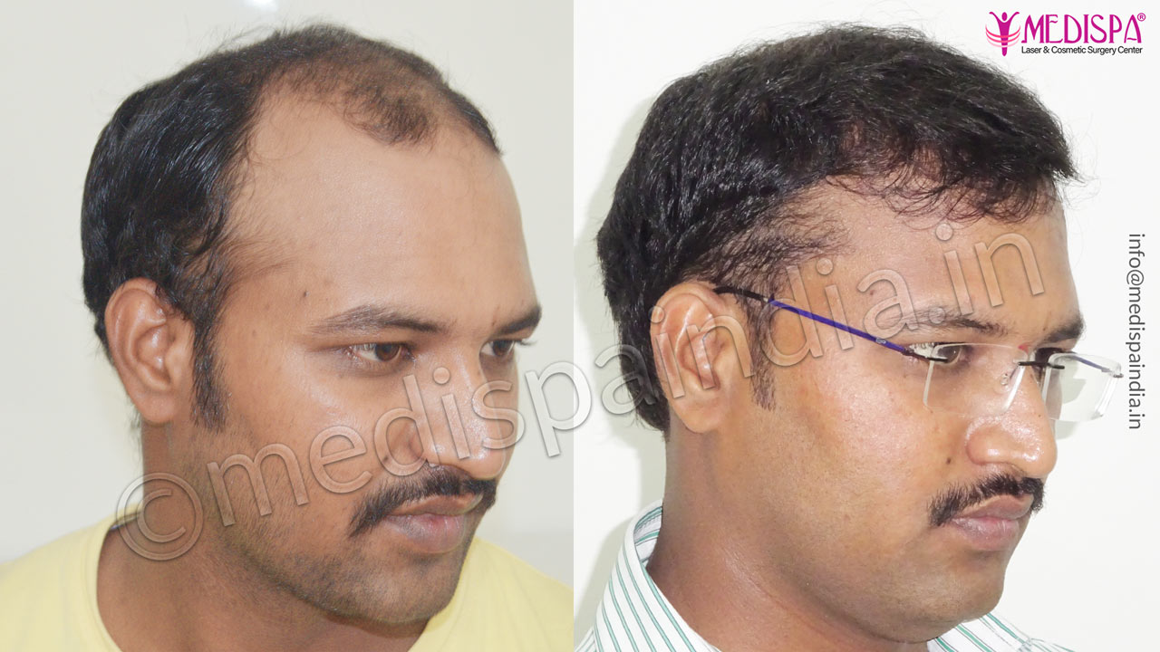 hair transplant cost bangalore