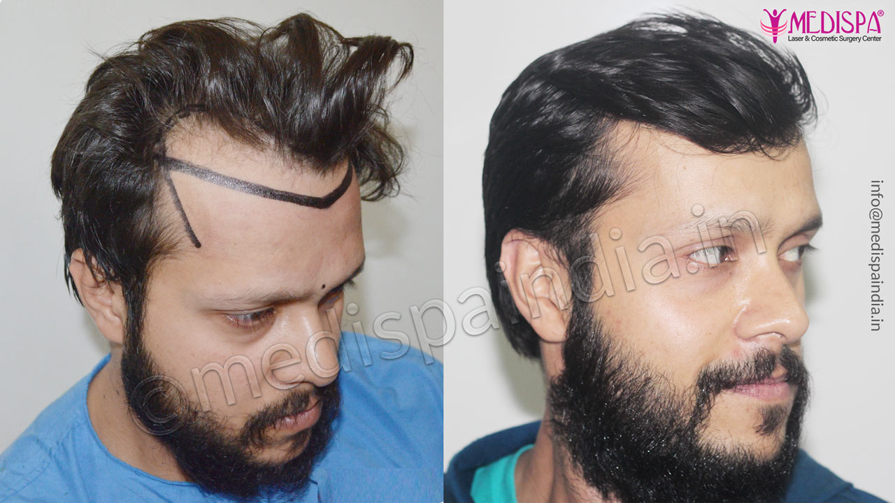 hair transplant cost chandigarh