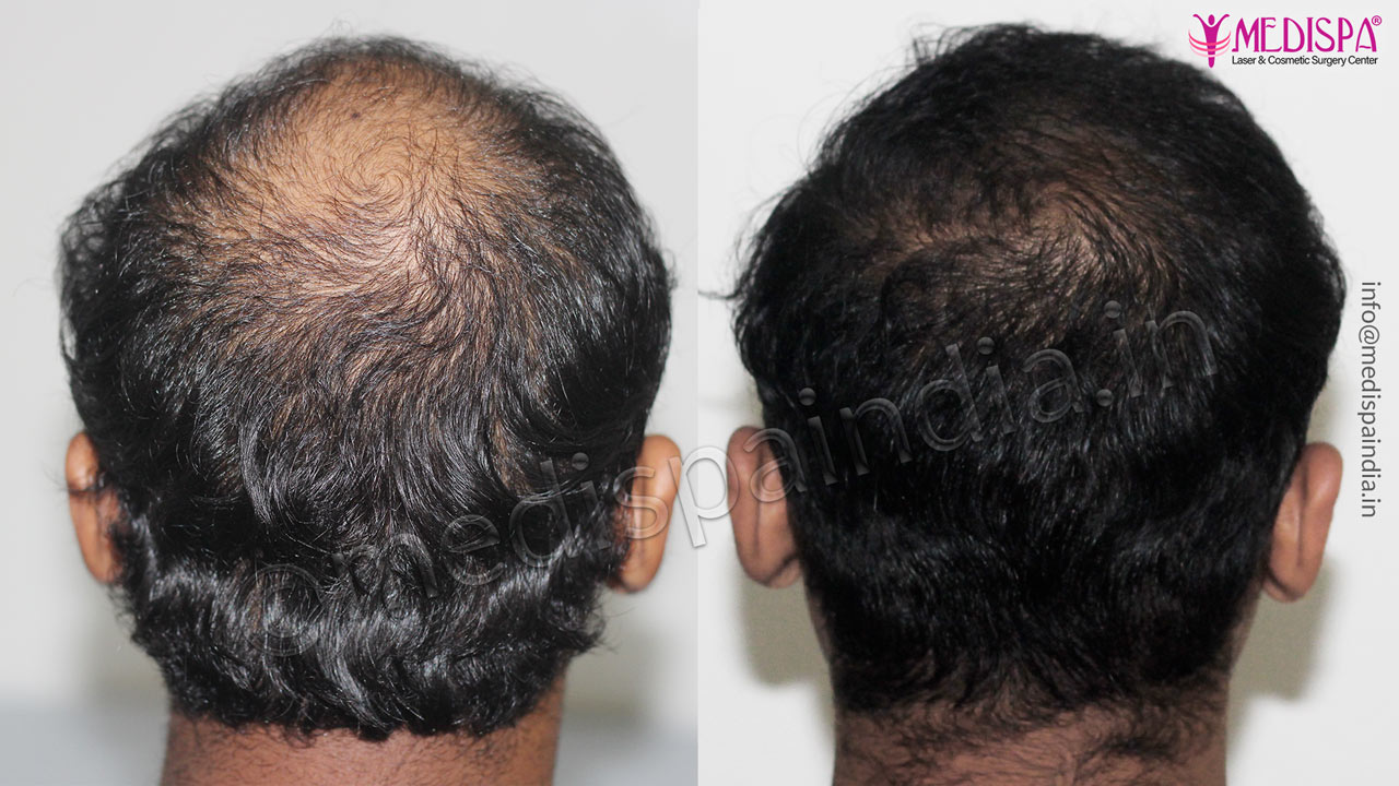 hair transplant cost delhi