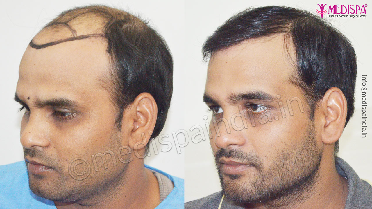 hair transplant cost in ahmedabad